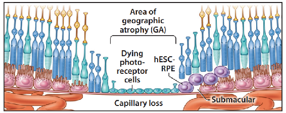 Pipeline 1: iPSC-RPEC transplantation therapy for the treatment of dry age-related macular degeneration (AMD)