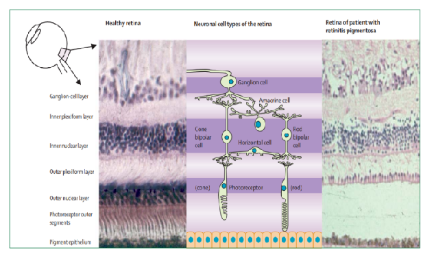 Pipeline 3: iPSC-RPC transplantation for the treatment of retinitis pigmentosa